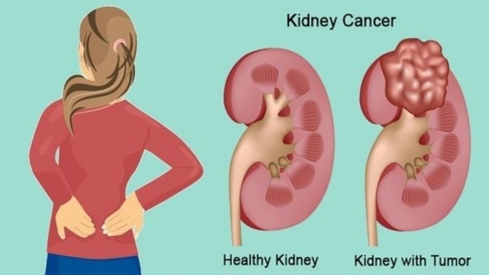 Informasi Tentang Penyakit Kanker Ginjal (Kidney Cancer)